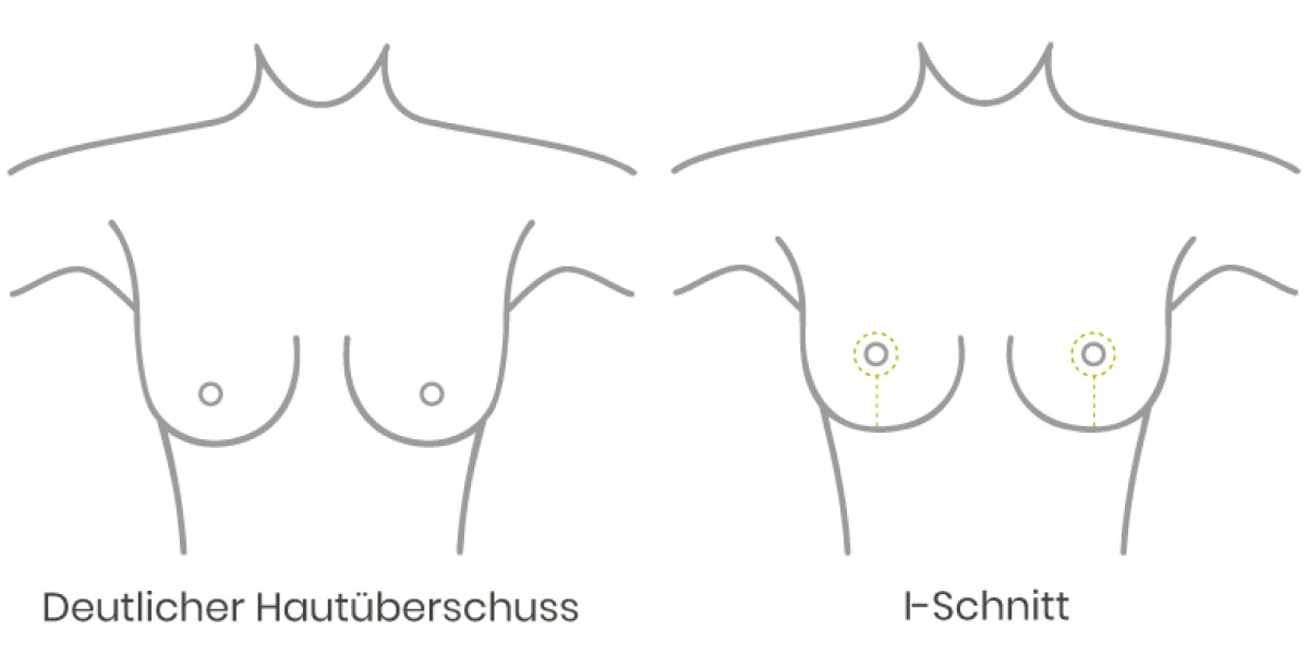  deutlicher Hautüberschuss bei einer Brust