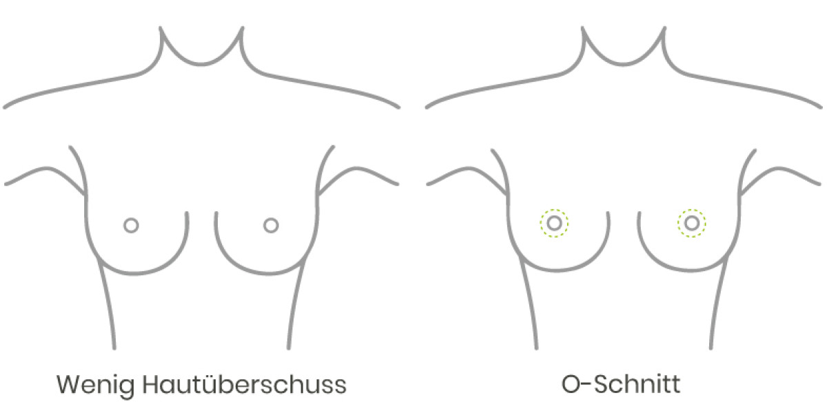 weniger Hautüberschuß bei einer Brust