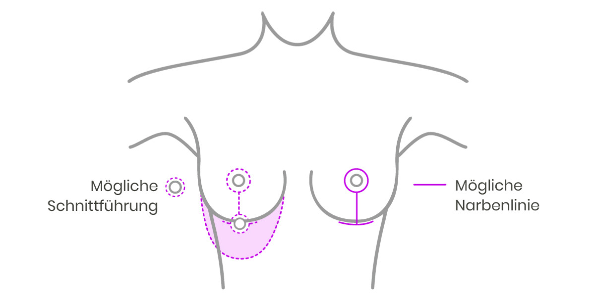 T-Schnittführung bei der Bruststraffung und Brustverkleinerung