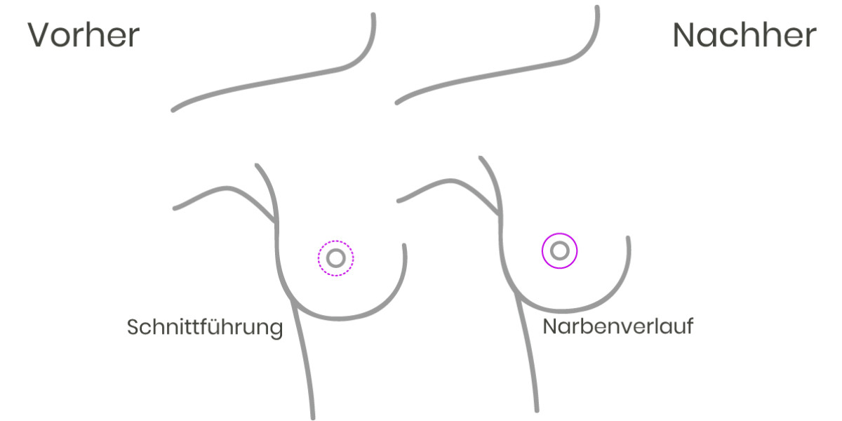 O-Schnittführung bei der Bruststraffung und Brustverkleinerung