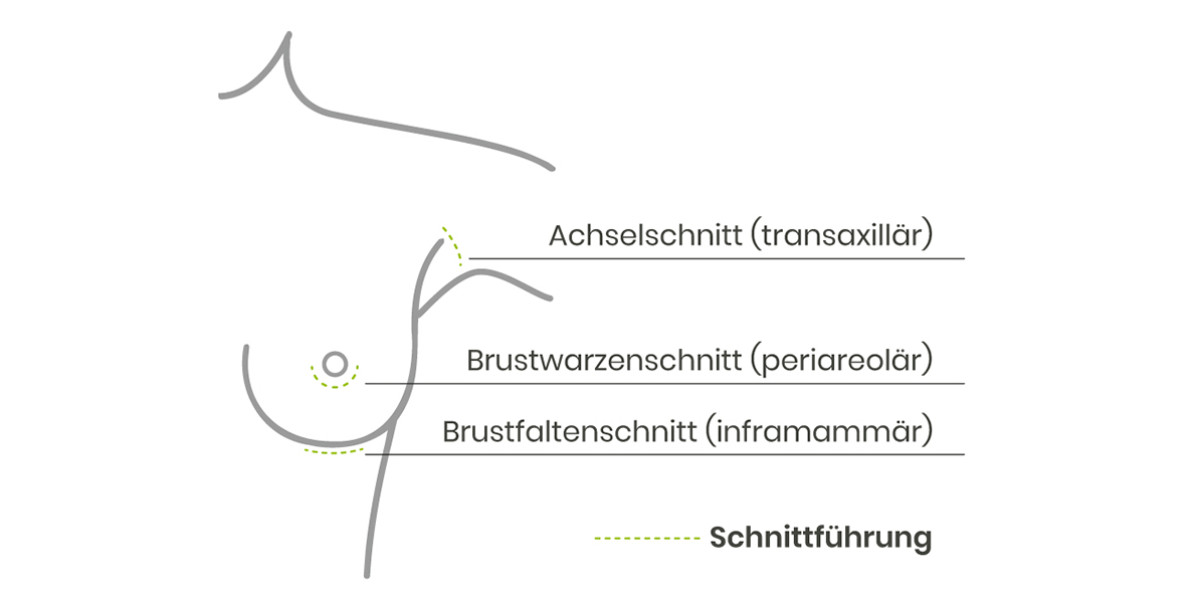 Die Schnittführungen bei einer Brustvergrößerung mit Implantaten