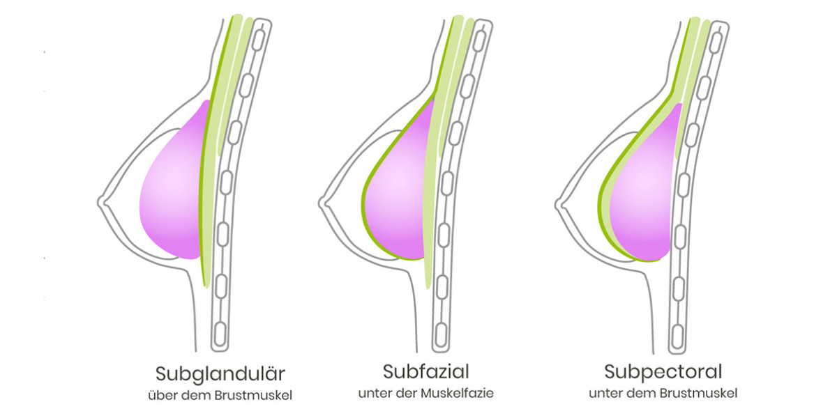 Brustimplantate München