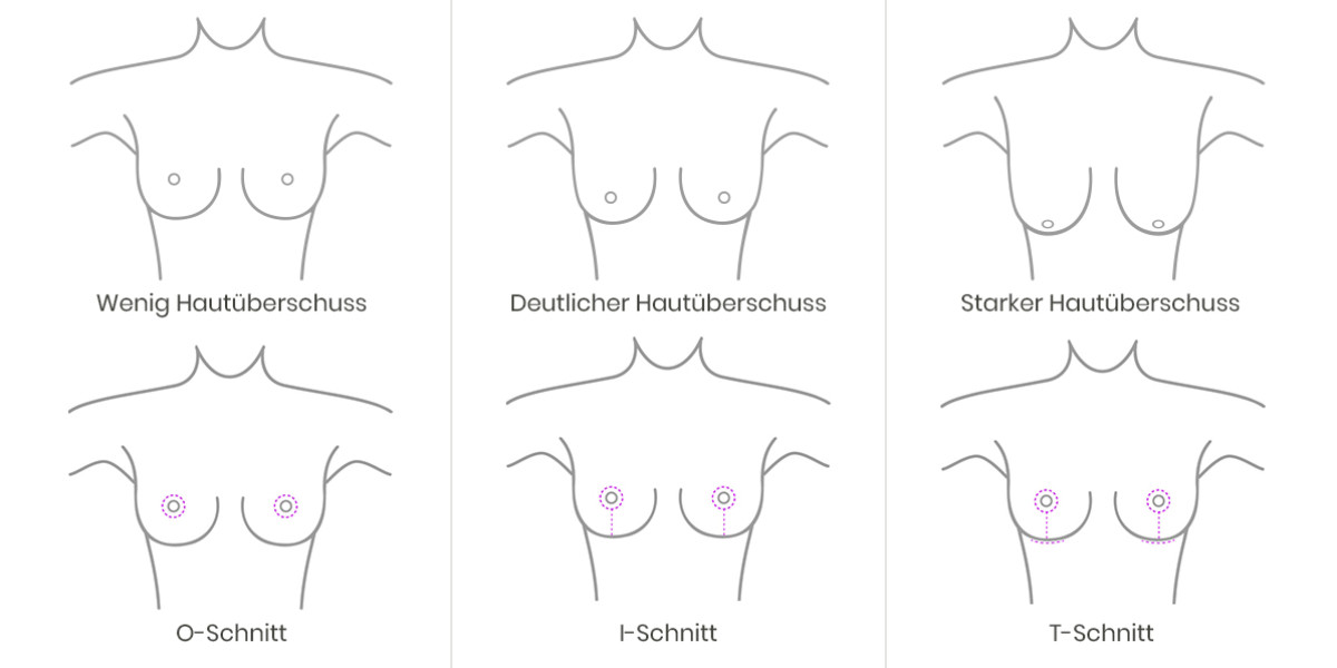 OP Techniken der Brustverkleinerung und der Bruststraffung