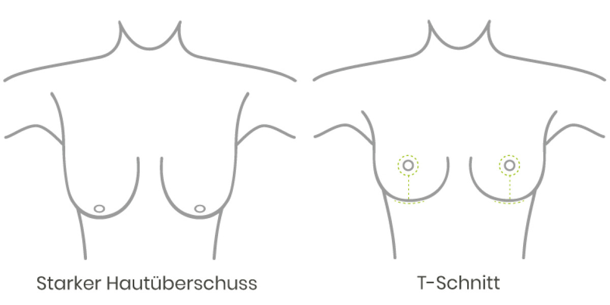 starker Hautüberschuss bei einer weiblichen Brust