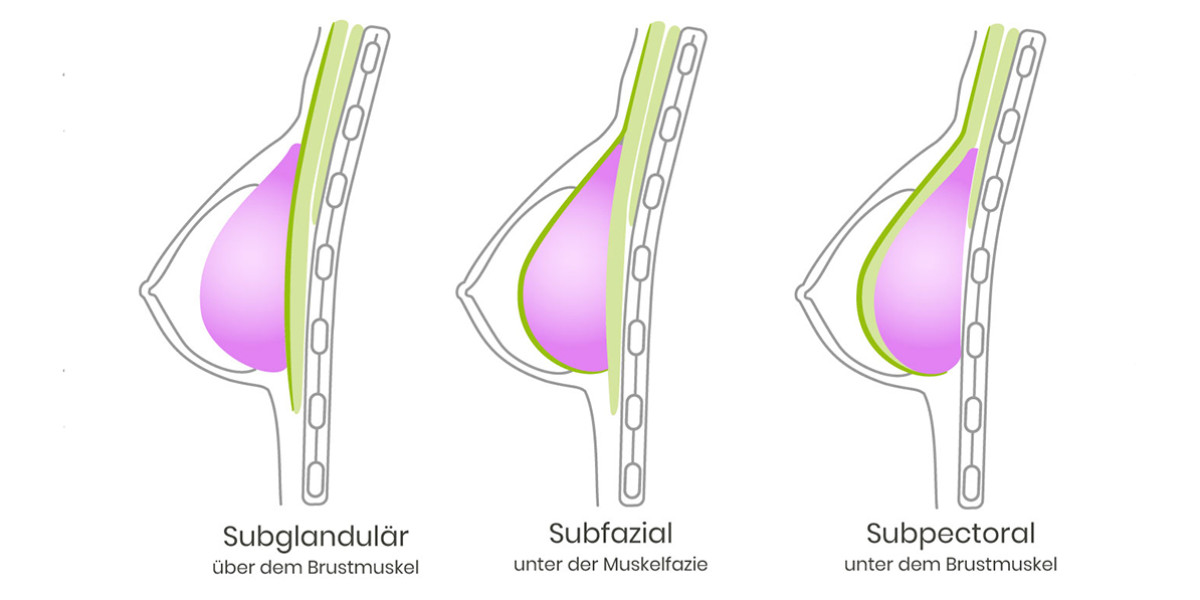 Platzierung des Brustimplantats bei einer Brustvergrößerung