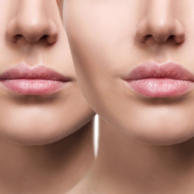 Vorher/Nachher Bild einer Lippenvergrößerung
